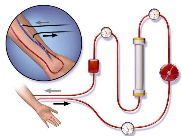 血液透析器端蓋專用塑料，你找對生產廠家了嗎？